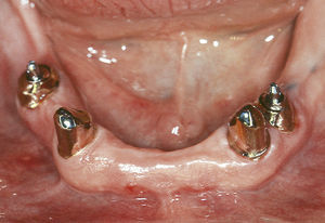 Combinación simétrica de coronas telescópicas sobre dientes vitales con cofias de espiga radicular y anclajes cilíndricos sobre dientes pilares endodonciados.