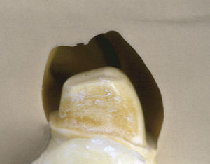 Comprobación de la eliminación de sustancia en los dientes pilares mediante la llave de silicona del montaje dental diagnóstico.