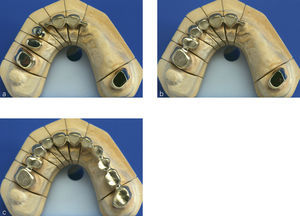 Estructura secundaria de varias piezas de la construcción de puente de las figuras 3 y 5 con puntos de unión en forma de barra para la adhesión sin tensiones en boca del paciente.