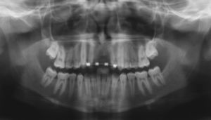 Ortopantomografía con aparato multibrackets parcial para la reposición de los dientes 11 y 21.