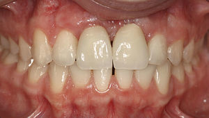 Situación intraoral tras la restauración implantosoportada de los dientes 11 y 21.