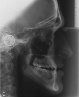 Radiografía cefalométrica lateral del inicio del tratamiento.
