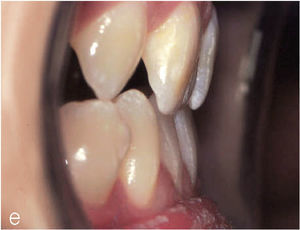 Resalte de los dientes an-teriores al principio del tratamiento.