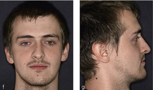 Fotografías frontal y de perfil tras la conclusión del tratamiento.