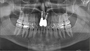 Radiografía panorámica tomada al principio del tratamiento ortodóncico (10 años después de la colocación de implantes en la región de los incisivos centrales superiores).