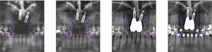 Descripción radiográfica del curso del tratamiento. (a) 4 años, (b) 9 años, y (c) 10 años después de la colocación de implantes (situación antes del tratamiento ortodóncico). (d) Once años después de la colocación de implantes (situación después de la conclusión del tratamiento ortodóncico). (a a c) Inhibición clara del crecimiento de hueso vertical periimplantario que incluye a los incisivos laterales adyacentes (perdida de hueso marginal alrededor de las superficies dentarias adyacentes al implante); (d) mejoría del nivel de hueso marginal gracias al tratamiento ortodóncico así como alineamiento de los incisivos laterales superiores con los caninos. Flechas azules, nivel de hueso marginal; flechas rosas, bordes incisales de los incisivos laterales y caninos superiores.