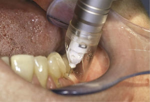 Situación clínica tras la anestesia de la mucosa y la perforación del hueso compacto con la cánula.