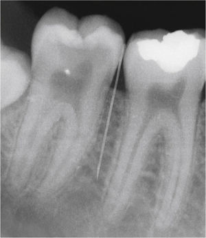 Representación radiológica de la posición interradicularparaapical de la cánula durante la anestesia de molares inferiores (fotografía: empresa Dental Hi Tec).