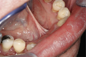 Paciente de 33 años con apiñamiento de los dientes. a) Dientes anteriores inferiores. b) Vista lingual de los dientes del maxilar inferior. c) Dientes anteriores superiores. d) Vista palatina de los dientes anteriores del maxilar superior.