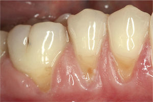 Cuello dental hipersensible que se tratará con la pasta dentífrica Elmex® Sensitive Professional™ Des- ensitizing Paste.