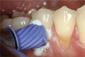 La pasta se toma y se aplica utilizando una copa de profilaxis convencional.