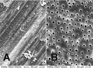 Imagen obtenida mediante el microscopio electrónico de barrido de una capa de barrillo dentina- rio (A) y dentina tras la eliminación completa del barrillo dentinario (B). Los túbulos dentinarios están expuestos (1.000 aumentos).