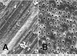 Imagen obtenida mediante el microscopio electrónico de barrido de una capa de barrillo dentina- rio (A) y dentina tras la eliminación completa del barrillo dentinario (B). Los túbulos dentinarios están expuestos (1.000 aumentos).