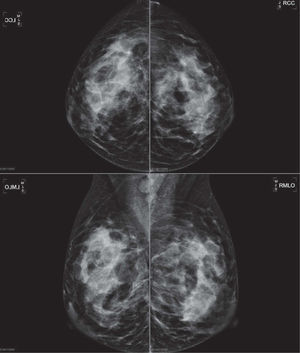 Mujer de 24 años, que acude por palparse tumoración de nueva aparición en cuadrante supero-externo de la mama izquierda. La mamografía muestra una zona asimétrica con efecto de masa de contornos mal delimitados, en el contexto de una mama de densidad aumentada, y una imagen a nivel de la axila izquierda de una adenopatía aumentada de tamaño, sin hilio y de morfología redondeada.