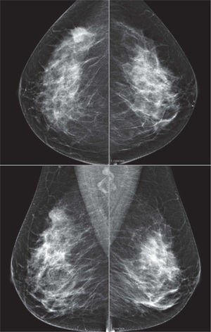 Mujer de 36 años que acude a causa de una lesión palpable de nueva aparición en el cuadrante superior externo de la mama izquierda. En la mamografía se observa una masa de contornos irregulares, en el contexto de una mama de densidad intermedia. No se identifican otras lesiones.