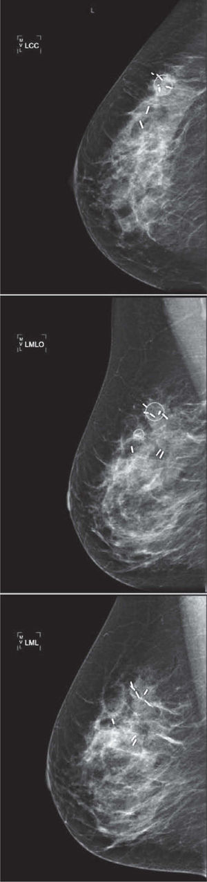 Se muestran las 3 proyecciones mamográficas empleadas de forma habitual para valorar la correcta colocación de los clips. Empleamos grapas de sutura quirúrgica automática de titanio, que se introducen en las lesiones a través del trócar coaxial empleado para la biopsia percutánea.