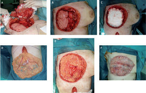 Procedimiento quirúrgico con resección de tumor y parte de pared torácica (A, B), colocación de prótesis sustitutiva (C), cobertura con colgajo omental (D, E) e injerto de piel libre (F).