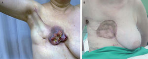 Imagen del tumor (A) y resultado final al año y medio de seguimi ento (B).