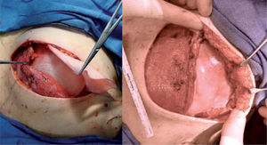 Imagen intraoperatoria de la cobertura de la prótesis con el músculo pectoral y la malla.