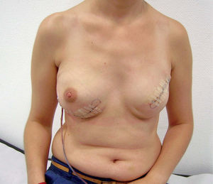 Mastectomía total izquierda y adenomastectomía de reducción de riesgo derecha con reconstrucción directa con prótesis y malla.