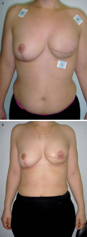 Mastectomía izquierda con reconstrucción y simetrización de la mama derecha.