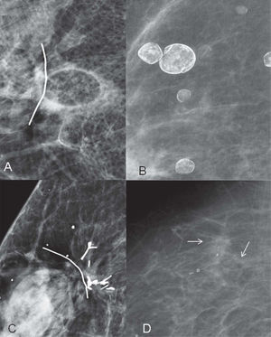 A) En la proyección mamográfica se aprecia una imagen ovalada, radiolucente, con una fina pared correspondiente a un quiste oleoso no calcificado adyacente al lecho quirúrgico. B) Quistes oleosos en diferentes fases de calcificación. C) Suturas quirúrgicas calcificadas, son calcificaciones gruesas y lineares. D) Antecedente de tumorectomía por carcinoma ductal in situ (CDIS) de grado III. La mamografía de control 4 años después del tratamiento muestra aparición de microcalcificaciones irregulares, finas y pleomórficas junto con un aumento de densidad, sospechosas de malignidad. Biopsia percutánea: carcinoma ductal infiltrante de grado II.