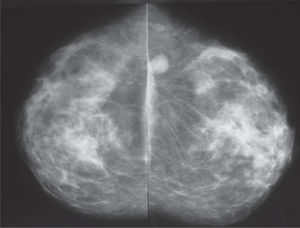 Mamografía en proyección cráneo-caudal. Demuestra que la lesión nodular es de localización en cuadrantes externos, próxima a la axila.