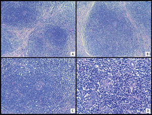 A. Parénquima mamario con denso infiltrado linfoide (HE ×10). B. El infiltrado se concentra alrededor de las unidades terminales (HE ×10). C. Los linfocitos muestran un tamaño homogéneo (HE ×20). D. Imágenes de lesión linfoepitelial (HE ×40).