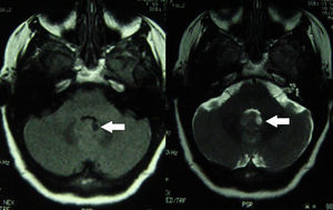 RM craneal T1 y T2. Lesión focal en nódulo izquierdo de vérmix cerebeloso. a) RM T1. b) RM T2.