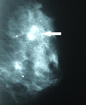 Mamografía oblicua lateral. Densidad asimétrica, de bordes mal definidos, con microcalcificaciones asociadas en CSE de mama izquierda.