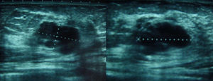 Ecografía de mama. Nódulo en CSE de mama izquierda de 2,3×1,3×2,2cm, sólida, irregular, hipoecoica, lobulada.