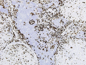 Expresión de la mamaglobina en las células de la adenopatía. Tinción con hematoxilina-eosina, x50.