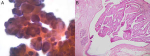 A) Extensión con células ductales en disposición seudopapilar sin atipias (compatible con papiloma). B) Conducto dilatado con una lesión constituida por papilas revestidas por una doble hilera celular (papiloma intraductal).