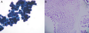 A) Extensión con células ductales en disposición seudopapilar sin atipias (compatible con papiloma). B) Tumoración compuesta por túbulos infiltrantes y áreas de carcinoma intraductal con patrón micropapilar (adenocarcinoma ductal infiltrante).