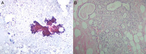 A) Extensión con grupos seudopapilares con desflecamiento de las células en la periferia y atipia citológica (carcinoma papilar). B) Área de conductos agrupados con un doble revestimiento celular sin atipias (adenosis).