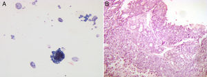 A) Extensión con células espumosas y detritus celulares (benigno). B) Tumoración epitelial que forma túbulos rodeados por células epiteliales con escasa atipia (adenocarcinoma ductal infiltrante).