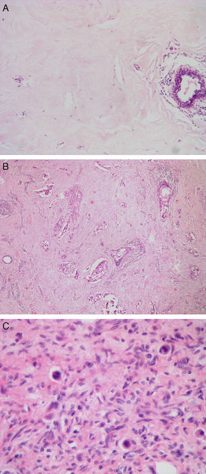 Reducción patológica: (A) completa (Miller y Payne 5, clase RCB 0). Estroma hialinizado sin celularidad tumoral. (B) Marcada (Miller y Payne 4, clase RCB I). Presencia de algunos túbulos y trabéculas de células tumorales en un estroma con fibrosis hialina. (C) Marcada (Miller y Payne 4, Clase RCB II). Presencia de escasas células tumorales aisladas de morfología histiocitoide en un estroma con marcada fibrosis.