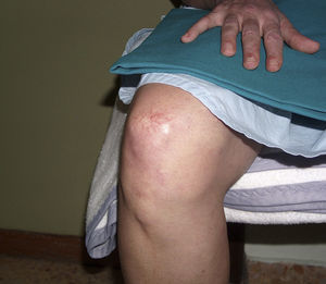 Lesiones cutáneas en dedos y rodilla con remisión incompleta tras 3 semanas de tratamiento corticoideo y antihistamínico. Aspecto previo a la cirugía.