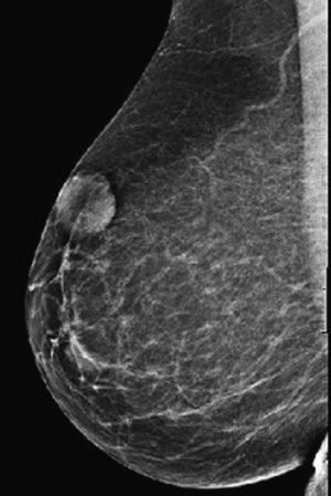 Mamografía. Imagen nodular con bordes bien definidos, situada en los intercuadrantes superiores de la mama derecha, de 31mm.