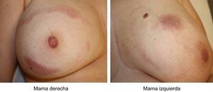 Lesiones cutáneas eritematosas no pruriginosas en mama derecha y mama izquierda.