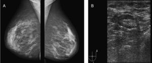 Pruebas complementarias. A. Mamografías. B. Ecografía de la mama izquierda, que muestra engrosamiento del tejido celular subcutáneo.