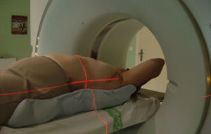 Inmovilización de mama conservada con cuña alfa, con alineamiento con láseres en la TAC para simulación virtual de radioterapia 3D conformada.