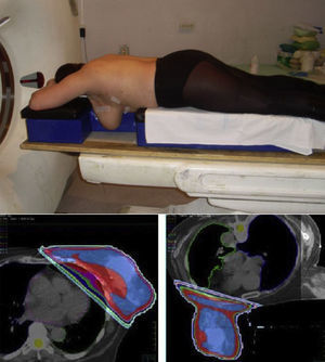 Posicionamiento en decúbito prono en una paciente con mama conservada izquierda. Líneas de isodosis en la planificación dosimétrica en supino y en prono, observando menos tejido pulmonar irradiado en prono.