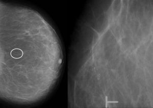 Paciente de 62 años. Mamografía de screening: aparición de grupo de microcalcificaciones amorfas. Biopsia con aguja gruesa por estereotaxia: atipia del epitelio plano. Cirugía: hiperplasia ductal atípica+atipia del epitelio plano.