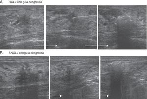 A) Cambio de ecogenicidad en el interior de la lesión si se realiza ROLL con guía ecográfica, o bien B) en la superficie de la lesión si se realiza SNOLL.