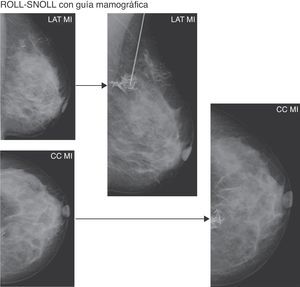 Comprobación con mamografía (proyección lateral estricta y craneocaudal) de la localización del radiotrazador con contraste yodado respecto a la lesión o clip metálico.CC MI: proyección craneocaudal mama izquierda; LAT MI: proyección lateral estricta mama izquierda.