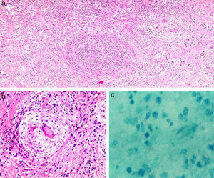 a) Conducto mamario, rodeado por células inflamatorias y algunas células multinucleadas tipo Langhans. b) Granuloma y células de Langhans. c) Bacilo de Koch positivo con coloración Ziehl-Neelsen 10×100.