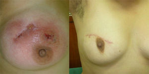 Paciente con tumor fistulizado en la mama derecha. En la foto de la derecha se puede observar cómo quedó después de la cirugía y de terminar el tratamiento antituberculoso.