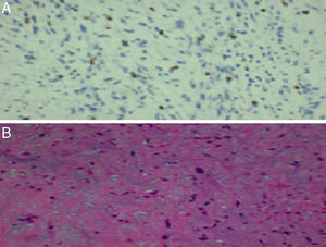 A)Índice de proliferación Ki 67. B)Imagen histológica con células mesenquimales fusiformes en un estroma mixoide (hematoxilina y eosina, ×10).