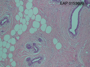 Histological examination of the excised breast tissue (hematoxylin–eosin, 100×), showing disorganized overgrowth of mammary tissues with variable amounts of fatty tissue, fibrotic stroma and epithelial elements.